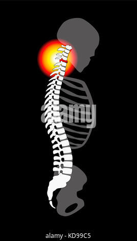 Prolapsus disque spinal - cou la douleur provoquée par des vertèbres cervicales - Vue de profil. illustration sur fond noir. Banque D'Images