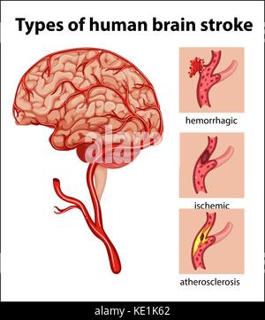 Types de maladies du cerveau humain illustration Illustration de Vecteur