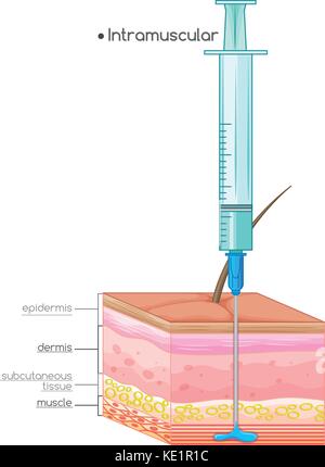 Schéma de l'injection intramusculaire illustration Illustration de Vecteur