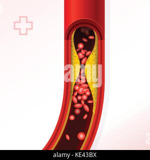 La section de l'artère avec l'accumulation de cholestérol - cholestérol et de thrombose Illustration de Vecteur