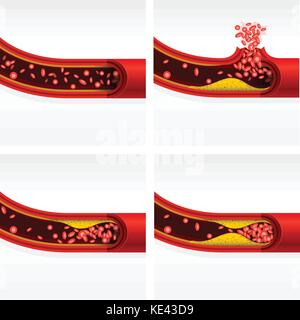 La section de l'artère avec le cholestérol et de thrombose cérébrale, accident vasculaire cérébral et de crise cardiaque Illustration de Vecteur