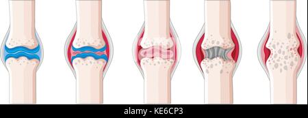La polyarthrite rhumatoïde dans le corps humain illustration Illustration de Vecteur