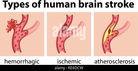 Types de maladies du cerveau humain illustration Illustration de Vecteur