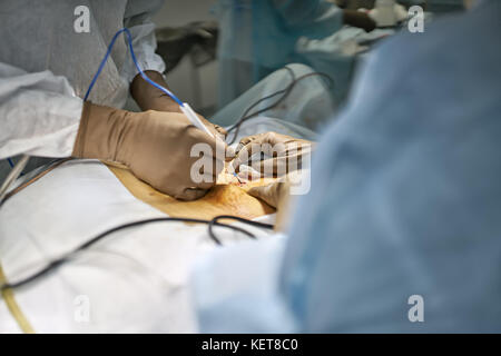 Médecin est faire une incision sur le ventre du patient avec le scalpel laser. sous l'aide. libre. à l'horizontale. Banque D'Images