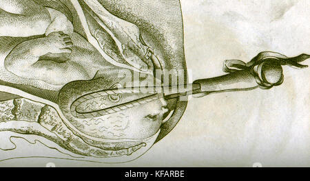 Dimensions de l'accouchement avec l'utilisation de forceps par William smellie, forceps obstétrical (1792) Banque D'Images