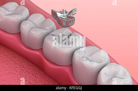 Metall obturations dentaires médicalement exacts, 3D illustration Banque D'Images