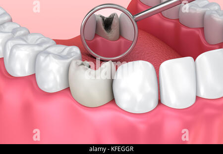 Inspection des dents avec miroir. Dent précise médicalement 3D illustration Banque D'Images