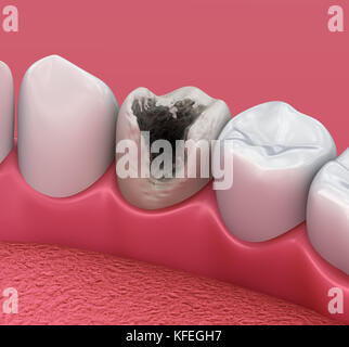 Dents caries, traitement. Illustration 3D des dents médicalement précises Banque D'Images