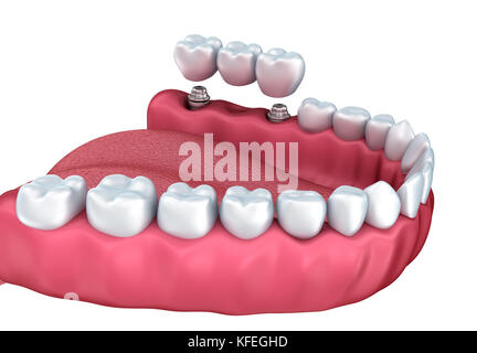 Processus de téléchargement d'implant médical , 3D illustration exacte style blanc Banque D'Images