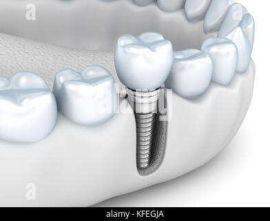 Processus de téléchargement d'implant médical , 3D illustration exacte style blanc Banque D'Images