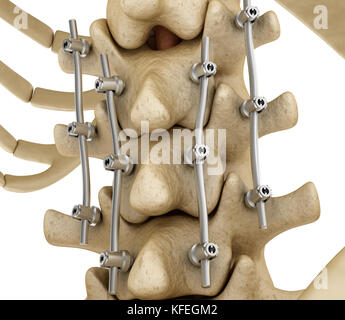 Système de fixation de la colonne vertébrale - titane support. Dent précise médicalement 3D illustration Banque D'Images