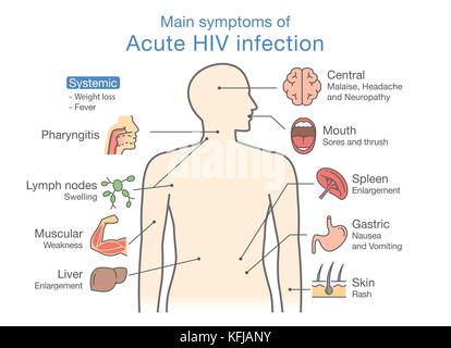 Principal symptôme de l'infection aiguë par le VIH. Illustration de Vecteur