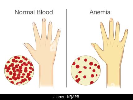 L'effet de l'anémie sur le flux sanguin dans la peau humaine. Illustration de Vecteur