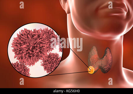Les droits de l'glande thyroïde montrant une tumeur et vue rapprochée de cellules de cancer de la thyroïde, l'illustration de l'ordinateur. Banque D'Images