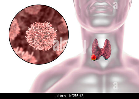 Les droits de l'glande thyroïde montrant une tumeur et vue rapprochée de cellules de cancer de la thyroïde, l'illustration de l'ordinateur. Banque D'Images