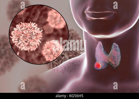 Les droits de l'glande thyroïde montrant une tumeur et vue rapprochée de cellules de cancer de la thyroïde, l'illustration de l'ordinateur. Banque D'Images