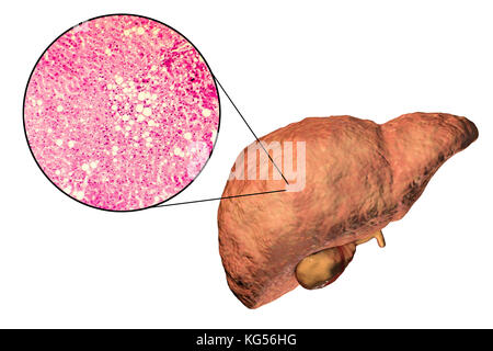 Foie gras. Illustration de l'ordinateur et la lumière Microphotographie d'une section à travers le foie d'un patient atteint d'une maladie du foie gras. Le foie gras est généralement associé à l'alcool ou de syndrome métabolique (diabète, hypertension et l'obésité), mais peut aussi être due à l'une des nombreuses causes. La stéatose hépatique est une condition réversible où de grandes vacuoles de graisse (cercles jaune pâle) s'accumulent dans les cellules du foie. Banque D'Images