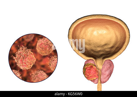 Le cancer de la prostate. Illustration d'ordinateur d'une tumeur cancéreuse à la prostate (à droite) et close-up view of prostate (à gauche). L'urètre peut être vu du centre de la prostate, de la vessie (en haut). Le cancer de la prostate est un des cancers les plus courants, de sexe masculin qui affecte généralement les personnes âgées. La croissance d'une tumeur de la prostate peuvent bloquer le col de la vessie, porter atteinte à la miction. Cependant, c'est un cancer à croissance lente. S'il est diagnostiqué, le traitement implique la chirurgie pour enlever la prostate, ou la radiothérapie. Banque D'Images