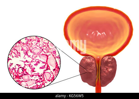 La lumière microphotographie (à gauche) et l'illustration de l'ordinateur (à droite) montrant l'hyperplasie. Une augmentation de l'Hyperplasie décrit le nombre de cellules en raison de la division cellulaire. Dans la prostate, la partie intérieure et ses environs stroma fibromusculaire hyperplasiques peuvent devenir. Ici, les acini pancréatiques (espaces blancs) sont bordées de hauts avec de petits noyaux de cellules basales ; le revêtement glandulaire apparaît attaché dans les plis papillaires (vu dans le centre de microphotographie). Acini adjacents sont séparés par fibromusculaire épaissie des tissus conjonctifs. Il y a dilatation cystique avec accumulation de matériel de sécrétion. Banque D'Images