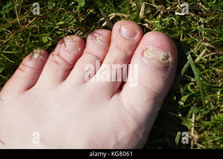 Onychomycose. infection fongique des ongles des pieds du jeune homme Banque D'Images