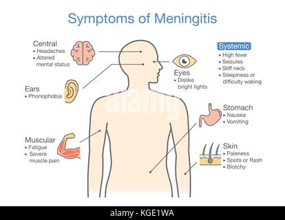 Diagramme pour montrer des symptômes des patients avec maladie méningite. Illustration de Vecteur