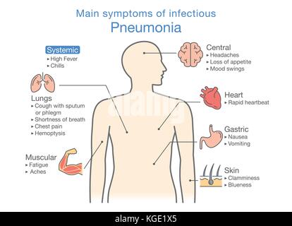 Schéma des principaux symptômes de pneumonie infectieuse. Illustration de Vecteur