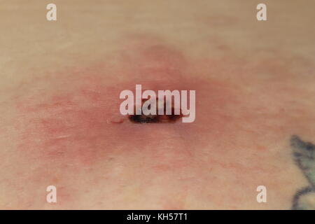 Morsure d'Araignée Recluse brune libre. Banque D'Images