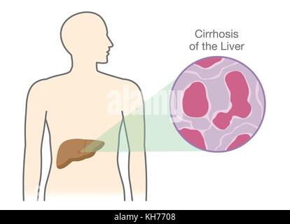 Montrant les cellules endommagées à la cirrhose du foie de personnes. Illustration de Vecteur