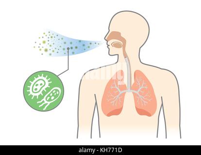 Les bactéries et les champignons dans les voies respiratoires des droits de l'de respirer. Illustration de Vecteur