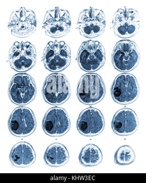 Voir irm de cerveau Tumeur au cerveau droit au lobe pariétal . Banque D'Images