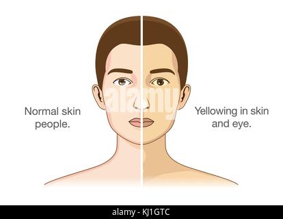 Les gens normaux et un jaunissement des yeux et de la peau. Illustration de Vecteur