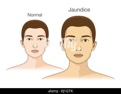 La comparaison entre la peau normale et le jaunissement de la jaunisse. Illustration de Vecteur