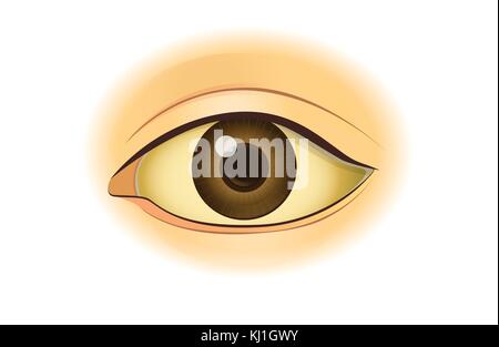 Le jaunissement de l'œil humain. Illustration de Vecteur