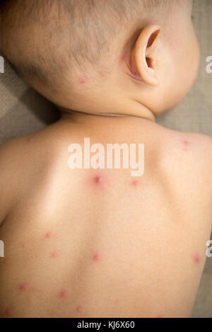 Bébé couché sur le canapé avec taches rouges de la varicelle à l'arrière, les photo. Banque D'Images