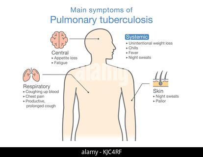 Principaux symptômes de la tuberculose pulmonaire du patient. Illustration de Vecteur