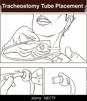 Vector illustration d'un placement du tube de trachéotomie Illustration de Vecteur