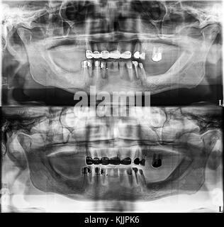 Rx dentaire panoramique fixe, les dents, l'amalgame dentaire, couronne dentaire et d'étanchéité, pont canal rempli Banque D'Images