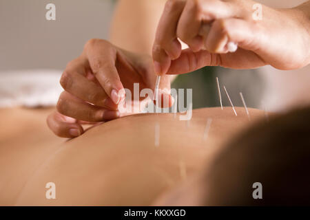 Le médecin bois aiguilles dans le corps de la femme sur l'acupuncture - close up Banque D'Images