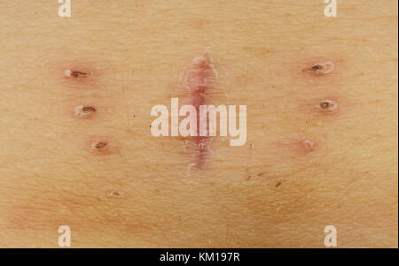 Hyst rectomie Photo Stock Alamy