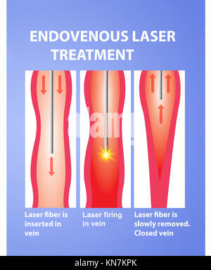 Varices et laser Banque D'Images