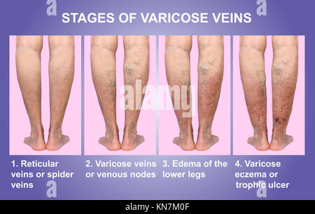 Varices sur une jambe senior femelle Banque D'Images