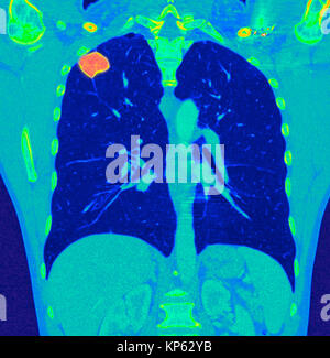 CTscan Couleur du haut de la poitrine montrant une tumeur dans les poumons. Banque D'Images
