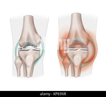 ARTHOPATHY ILLUSTRATION Banque D'Images