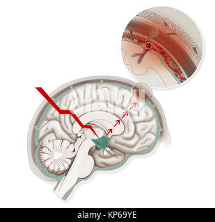 La MIGRAINE, ILLUSTRATION Banque D'Images