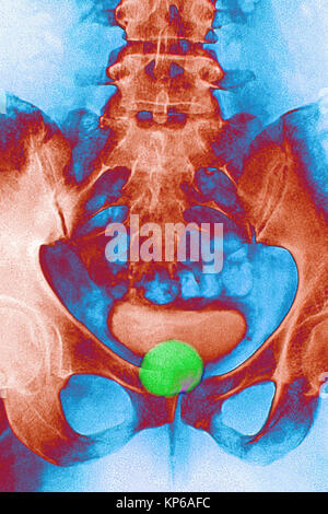 Meckel DANS LA VESSIE, X-RAY Banque D'Images