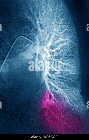 L'infarctus pulmonaire CORONAROGRAPHIE Banque D'Images