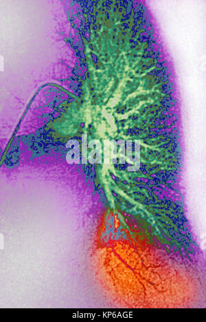 L'infarctus pulmonaire CORONAROGRAPHIE Banque D'Images