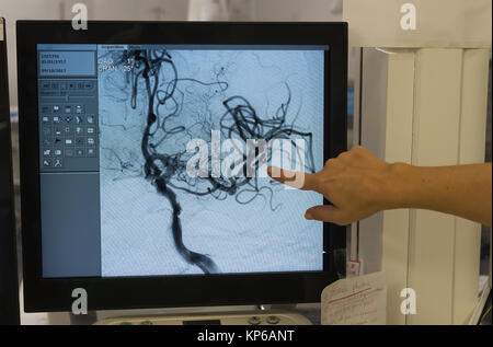 La neuroradiologie interventionnelle Banque D'Images