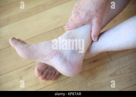 Les varicosités sur la cheville de l'homme Banque D'Images