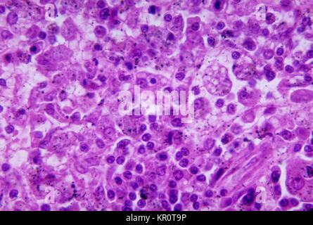 Cette microphotographie montre les changements histopathologiques associées à la cryptococcose de la rate, 1964. Histoplasmin tests positifs de la peau se produit dans jusqu'à 80  % des personnes vivant dans les zones où H. capsulatum est commun, comme l'Est et le centre des États-Unis. Les cellules de levure apparaissent comme des espaces clairs dans les histiocytes. Image courtoisie CDC/Dr. Martin Hicklin. Banque D'Images